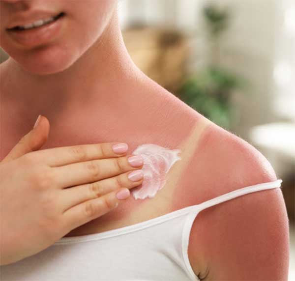 Phục hồi da cháy nắng sau khi đi du lịch